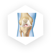 Joint replacement
